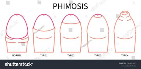 fimosis foto|Image: Fimosis